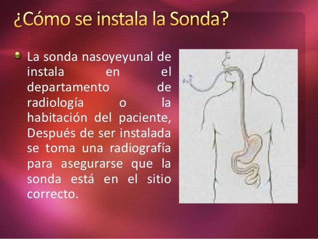 colocacion de sonda nasoyeyunal